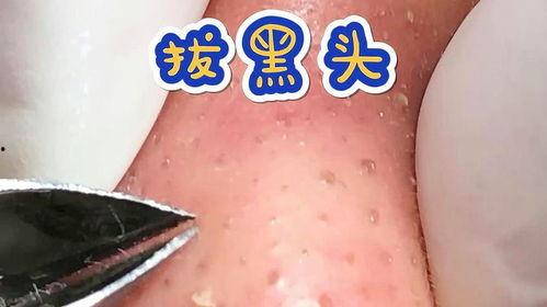 处理黑头视频,视频教程助你轻松清洁毛孔